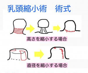 高さを縮小する場合、または直径を縮小する場合の術式